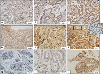 Evaluation of <mark class="highlighted">Galanin</mark> Expression in Colorectal Cancer: An Immunohistochemical and Transcriptomic Study